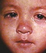 Above, wet eyes and nose and a red bumpy rash are symptoms of measles. [California Dept. of Public Health photo]